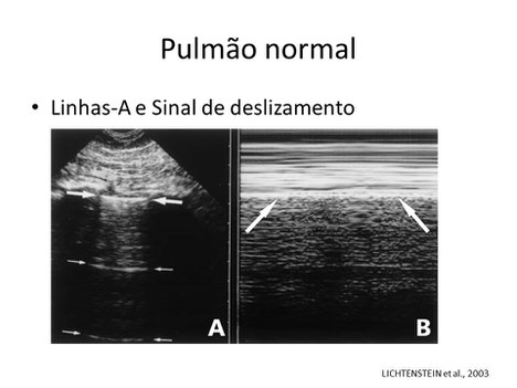 Imagem de ultrassom mostra marcas em pulmão saudável (Foto: Divulgação)