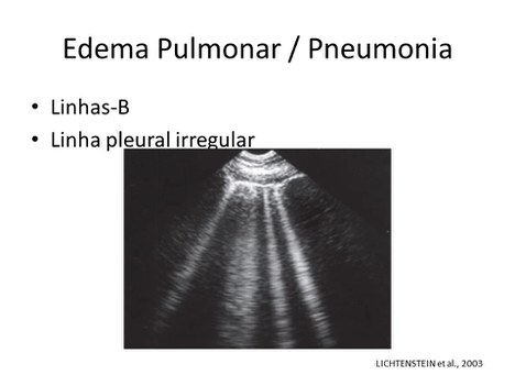 Imagem de ultrassom mostra marcas em pulmão com edema causado pelo coronavírus (Divulgação)