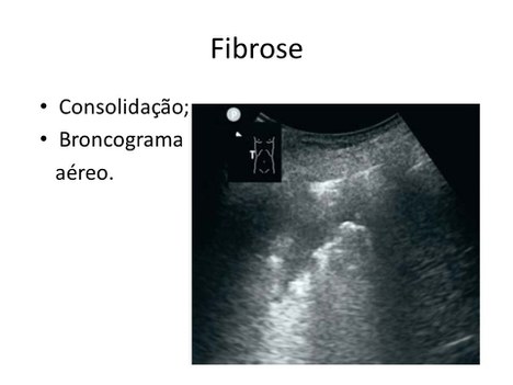 Imagem de ultrassom mostra marcas em pulmão com fibrose causada pelo coronavírus (Divulgação)