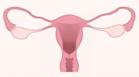 Conheça as recomendações para os cuidados à saúde de mulheres usuárias do Essure